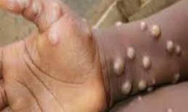 अफ़्रीका के बाहर दर्ज़ किया गया एमपॉक्स संक्रमण का पहला मामला