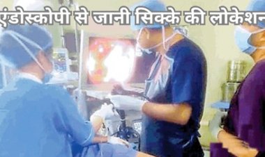 डीकेएस अस्पताल के डॉक्टरों की टीम ने बच्चे की आहार नली से बिना ऑपरेशन निकाला सिक्का