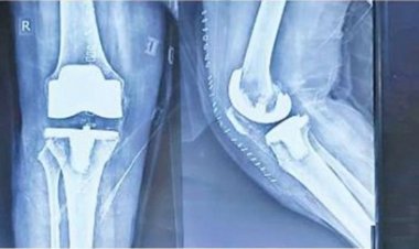 डॉक्टरों ने जटिल सर्जरी कर लौटाई बुजुर्ग के 'कदमों की चाल'