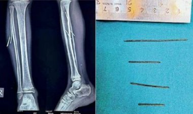 टायर फटने से बच्चे के पैरों में धंसे लोहे के 4 टुकड़े