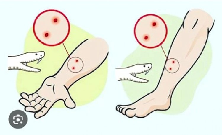 सांप डसे तो झाड़-फूंक में समय न गवाएं, तुरंत अस्पताल पहुंचे