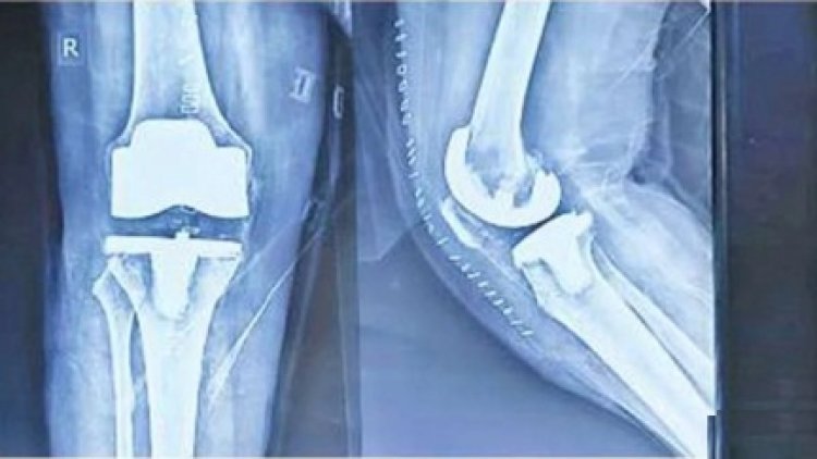 डॉक्टरों ने जटिल सर्जरी कर लौटाई बुजुर्ग के 'कदमों की चाल'