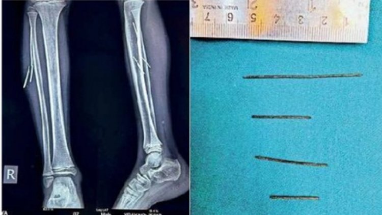 टायर फटने से बच्चे के पैरों में धंसे लोहे के 4 टुकड़े