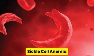 अब सिर्फ 20 रुपये में हो सकेगी सिकलसेल की जांच
