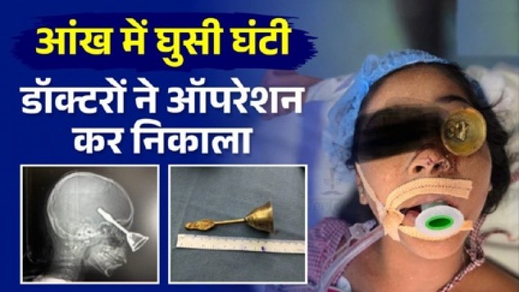 9 वर्षीय मासूम के आंख से होते हुए दिमाग में घुसी घंटी, डॉक्टरों ने ऑपरेशन कर निकाला