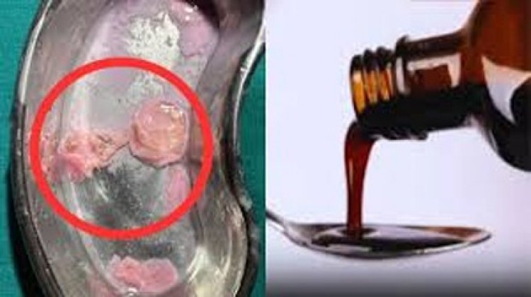 सीरप की बोतल में संदिग्ध वस्तु मिलने का मामला, जांच के लिए नमूने को भेजा गया राज्य औषधि परीक्षण प्रयोगशाला