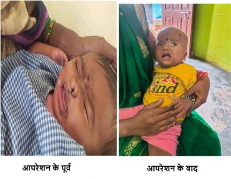 चिरायु योजना बच्चों के लिए भी बनी वरदान