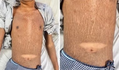 छत्तीसगढ़ में 19 साल के युवक में मिली दुर्लभ बीमारी, डॉक्टर भी हैरान