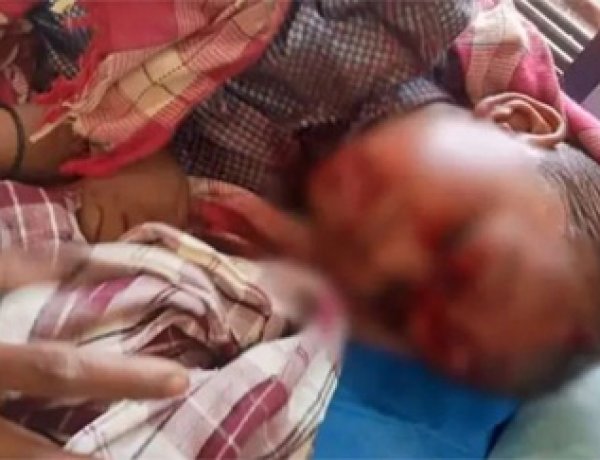 बालोद में कुत्ते का आतंक: 4 साल के मासूम पर हमला, 17 गंभीर जख्म