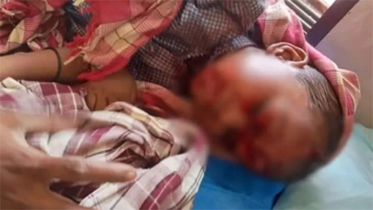 बालोद में कुत्ते का आतंक: 4 साल के मासूम पर हमला, 17 गंभीर जख्म